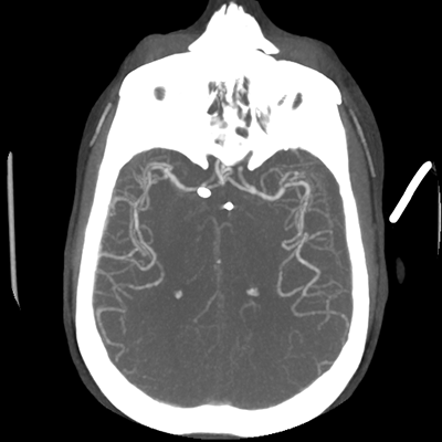 CTA head (MIP) 10/17