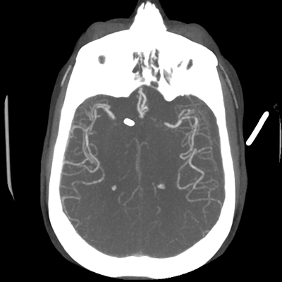 CTA head (MIP) 11/17