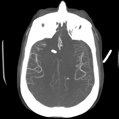 CTA head (MIP) 12/17