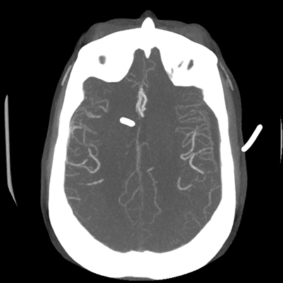 CTA head (MIP) 13/17