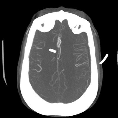 CTA head (MIP) 14/17