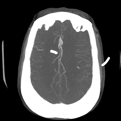 CTA head (MIP) 15/17