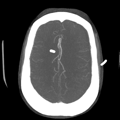 CTA head (MIP) 17/17
