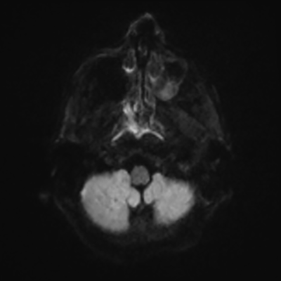 MRI brain (DWI) 1/24
