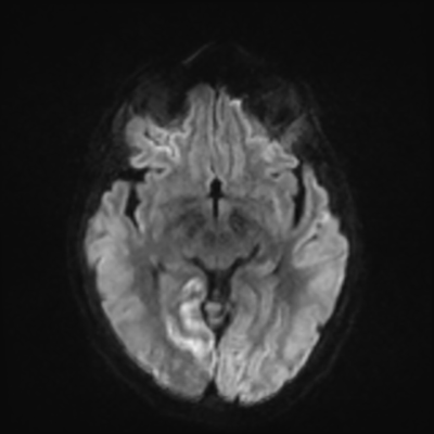 MRI brain (DWI) 10/24