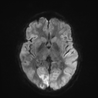 MRI brain (DWI) 12/24
