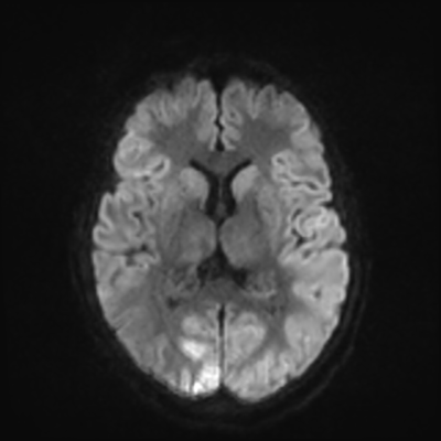 MRI brain (DWI) 13/24