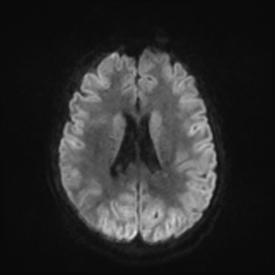 MRI brain (DWI) 15/24
