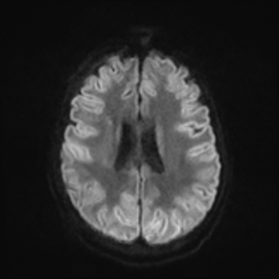MRI brain (DWI) 16/24