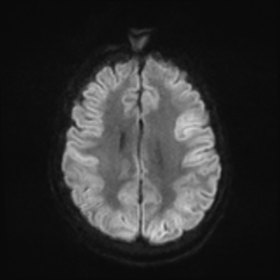 MRI brain (DWI) 17/24