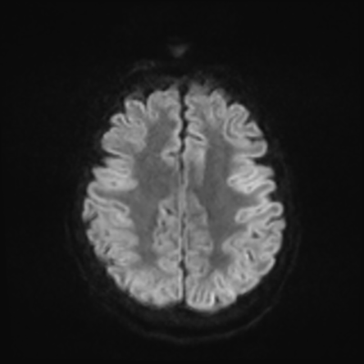 MRI brain (DWI) 18/24