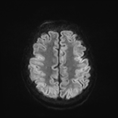 MRI brain (DWI) 19/24