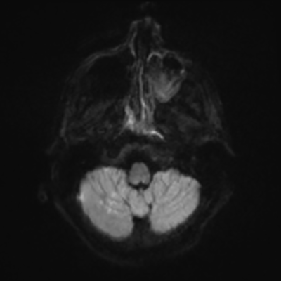 MRI brain (DWI) 2/24