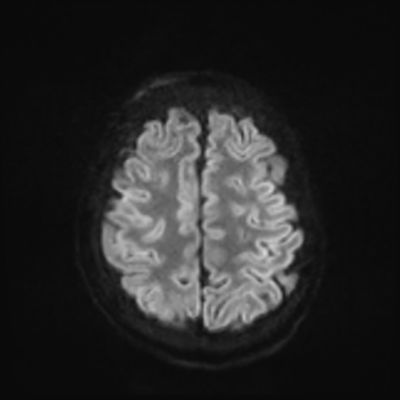 MRI brain (DWI) 20/24