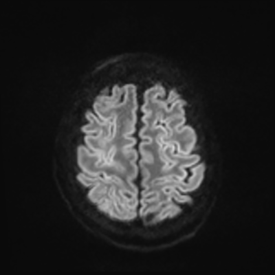 MRI brain (DWI) 21/24