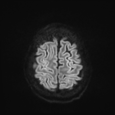 MRI brain (DWI) 22/24