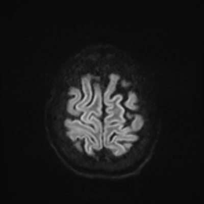 MRI brain (DWI) 23/24