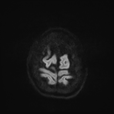 MRI brain (DWI) 24/24