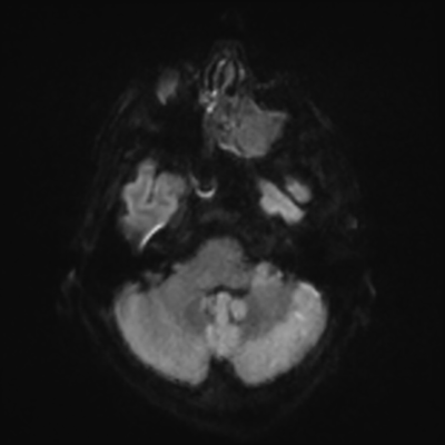 MRI brain (DWI) 4/24