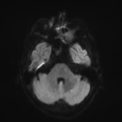 MRI brain (DWI) 5/24