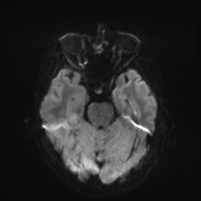 MRI brain (DWI) 7/24