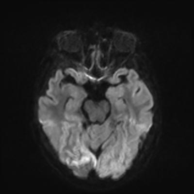 MRI brain (DWI) 8/24