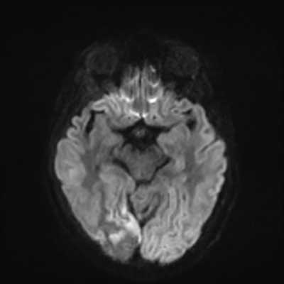 MRI brain (DWI) 9/24
