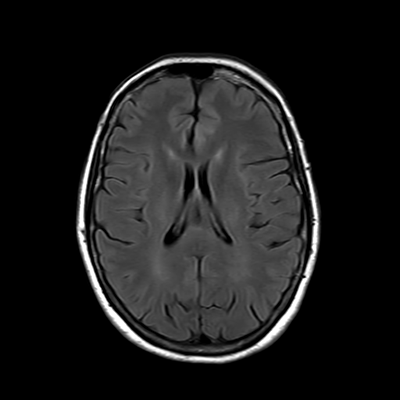 MRI brain (FLAIR) 12/18