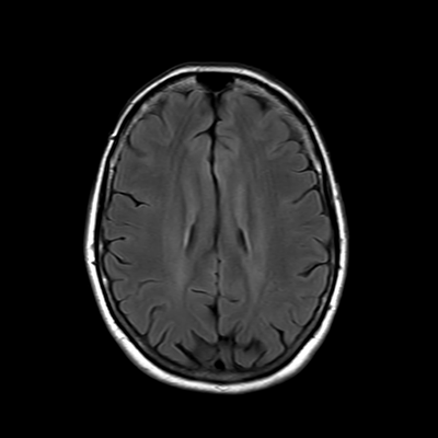 MRI brain (FLAIR) 13/18
