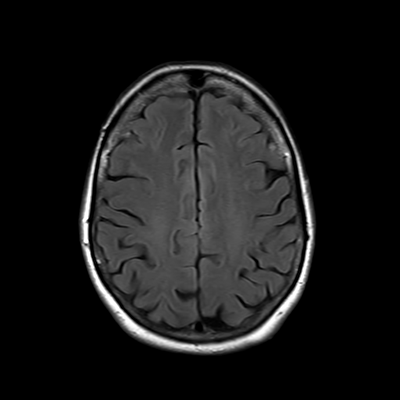 MRI brain (FLAIR) 14/18