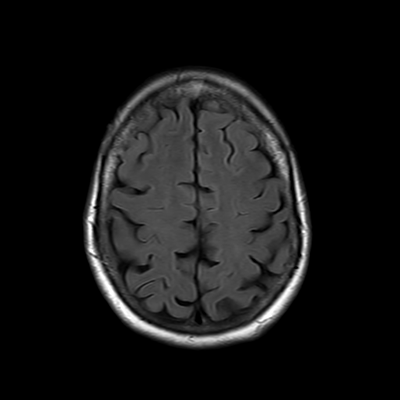 MRI brain (FLAIR) 15/18