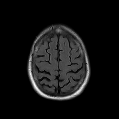 MRI brain (FLAIR) 16/18