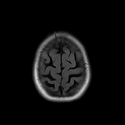 MRI brain (FLAIR) 17/18
