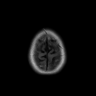 MRI brain (FLAIR) 18/18