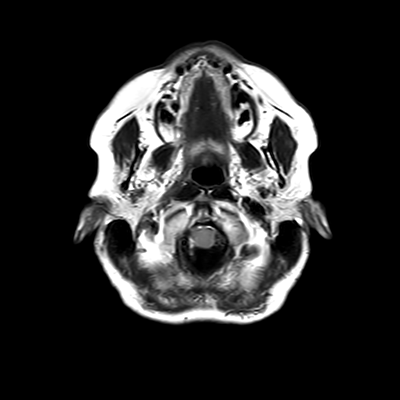 MRI brain (FLAIR) 2/18