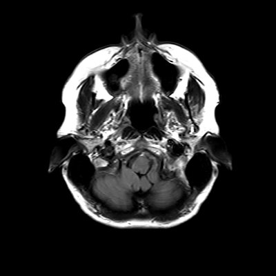 MRI brain (FLAIR) 3/18
