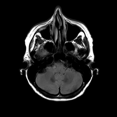 MRI brain (FLAIR) 5/18