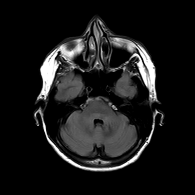 MRI brain (FLAIR) 6/18