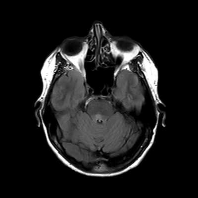 MRI brain (FLAIR) 7/18