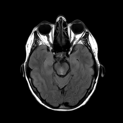 MRI brain (FLAIR) 8/18