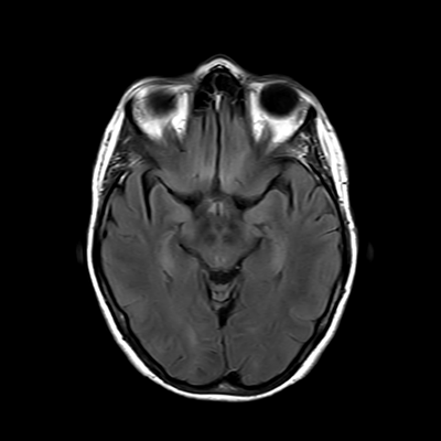 MRI brain (FLAIR) 9/18