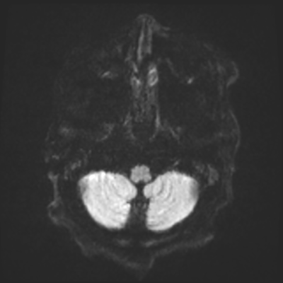 MRI brain (DWI) 1/24