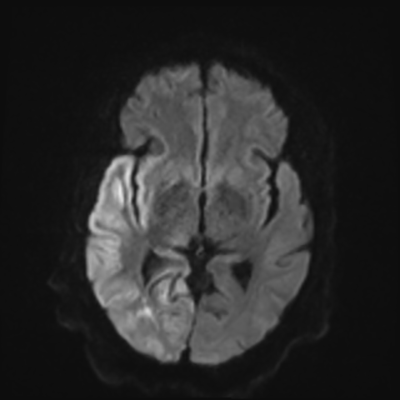 MRI brain (DWI) 10/24