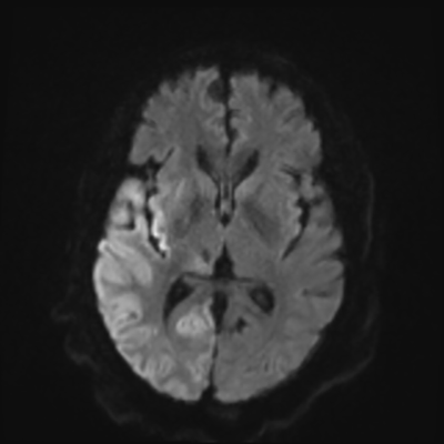 MRI brain (DWI) 11/24