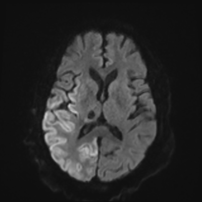 MRI brain (DWI) 12/24