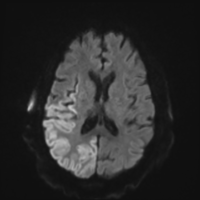 MRI brain (DWI) 13/24