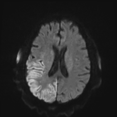 MRI brain (DWI) 14/24