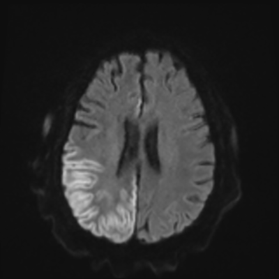 MRI brain (DWI) 15/24