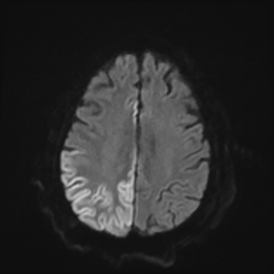 MRI brain (DWI) 16/24