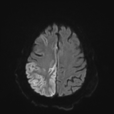 MRI brain (DWI) 17/24
